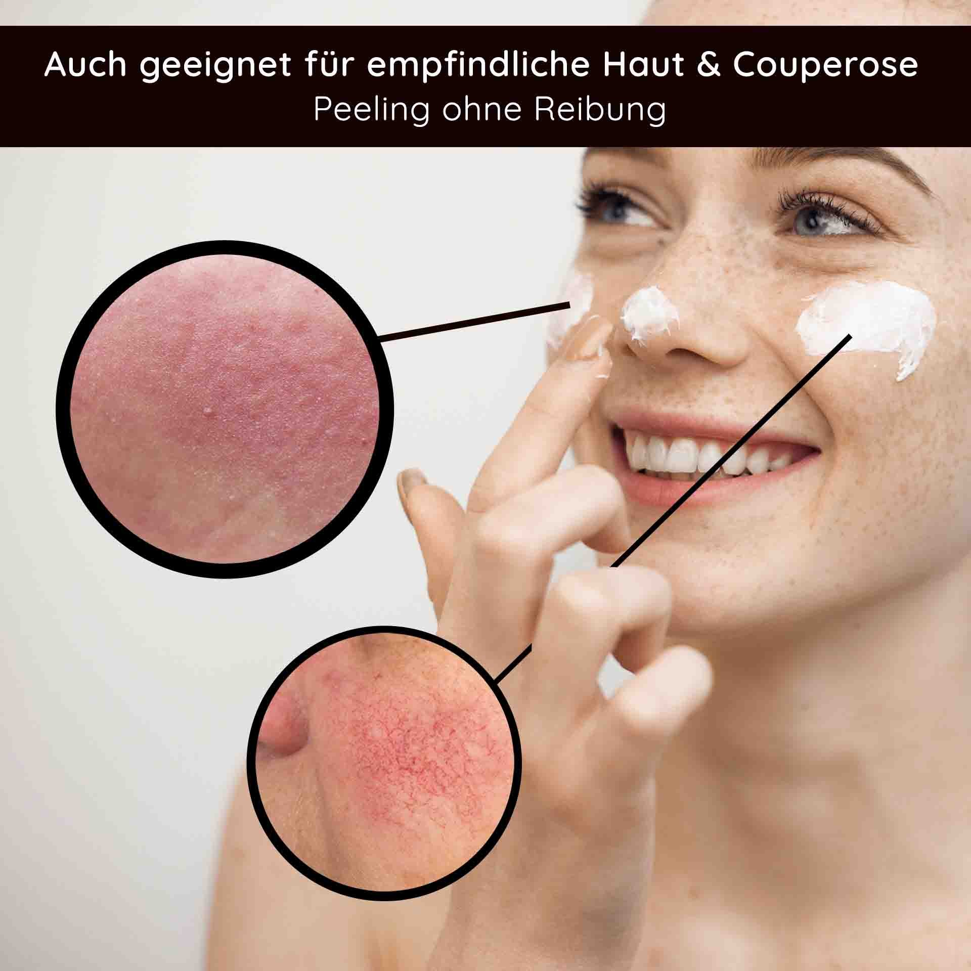 Woman with a joyful smile applying a fruit acid peeling to her face, with close-ups of sensitive skin and redness, suitable for sensitive skin and Couperose, peeling without friction.
