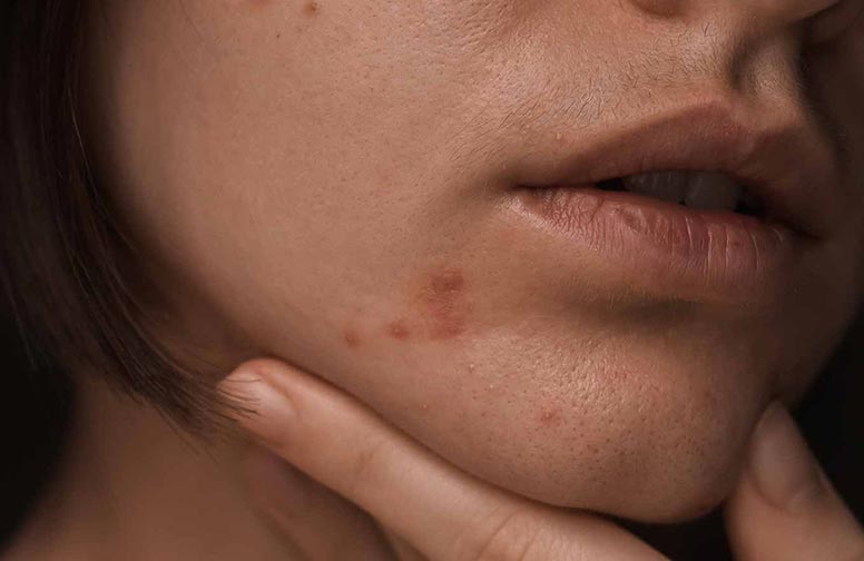 Perioral dermatitis - causes and treatment of oral erysipelas