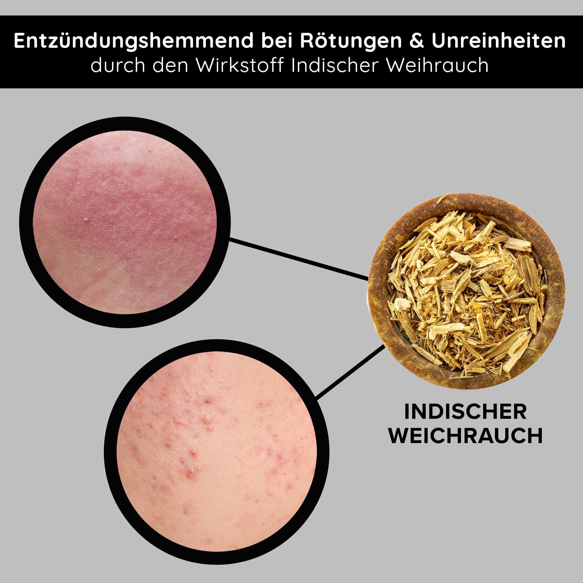 Anti-inflammatory Indian frankincense for reducing redness and impurities, with close-ups of affected skin.