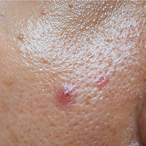 RAU_Cosmetics-Produktberater-fettige-unreine-Haut Nahaufnahme von Haut mit Poren und Rötungen zur Vermarktung des RAU Cosmetics Powersets für unreine Haut.