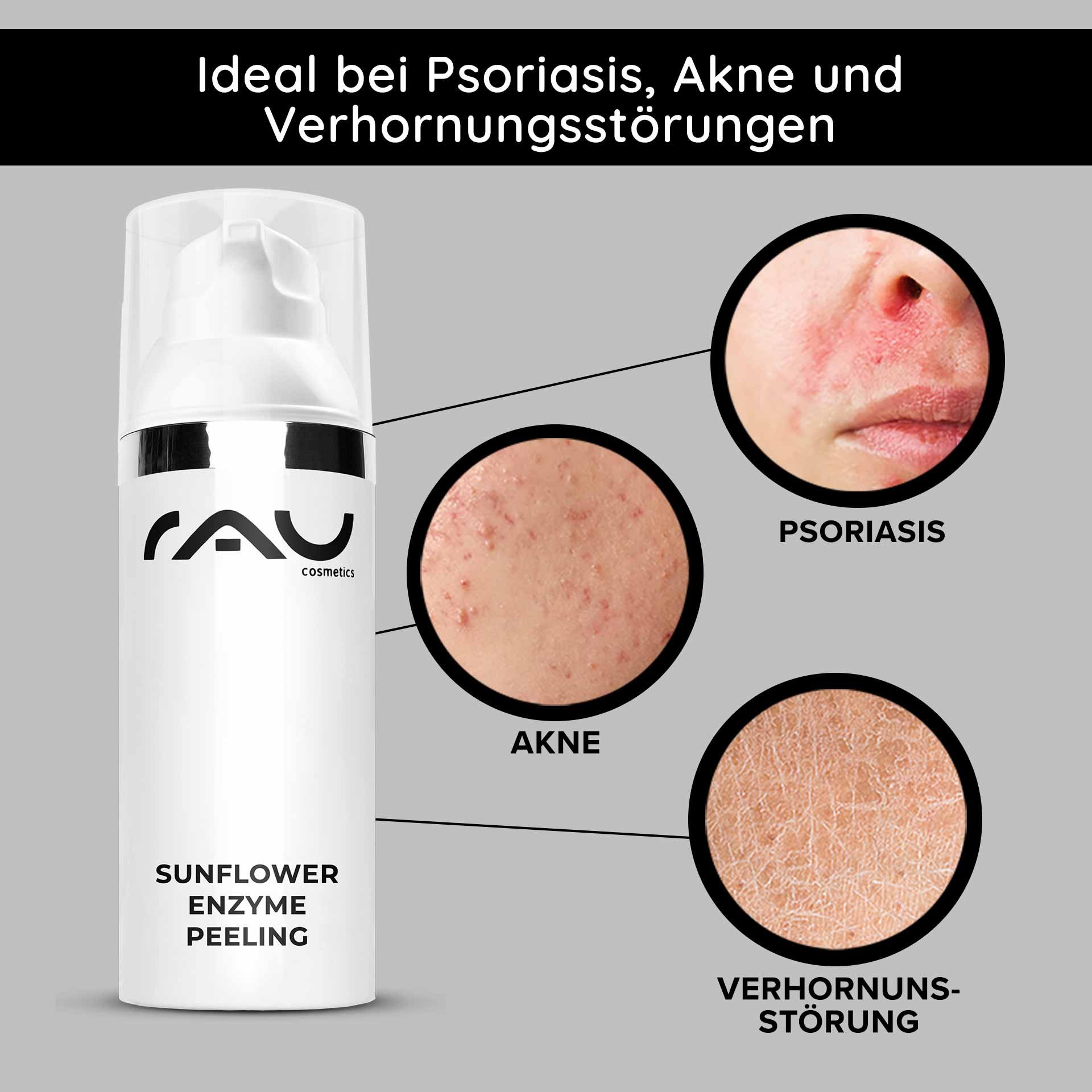 Packaging of the Sunflower Enzyme Peeling by RAU Cosmetics with highlighted skin problems: psoriasis, acne, and hyperkeratosis.