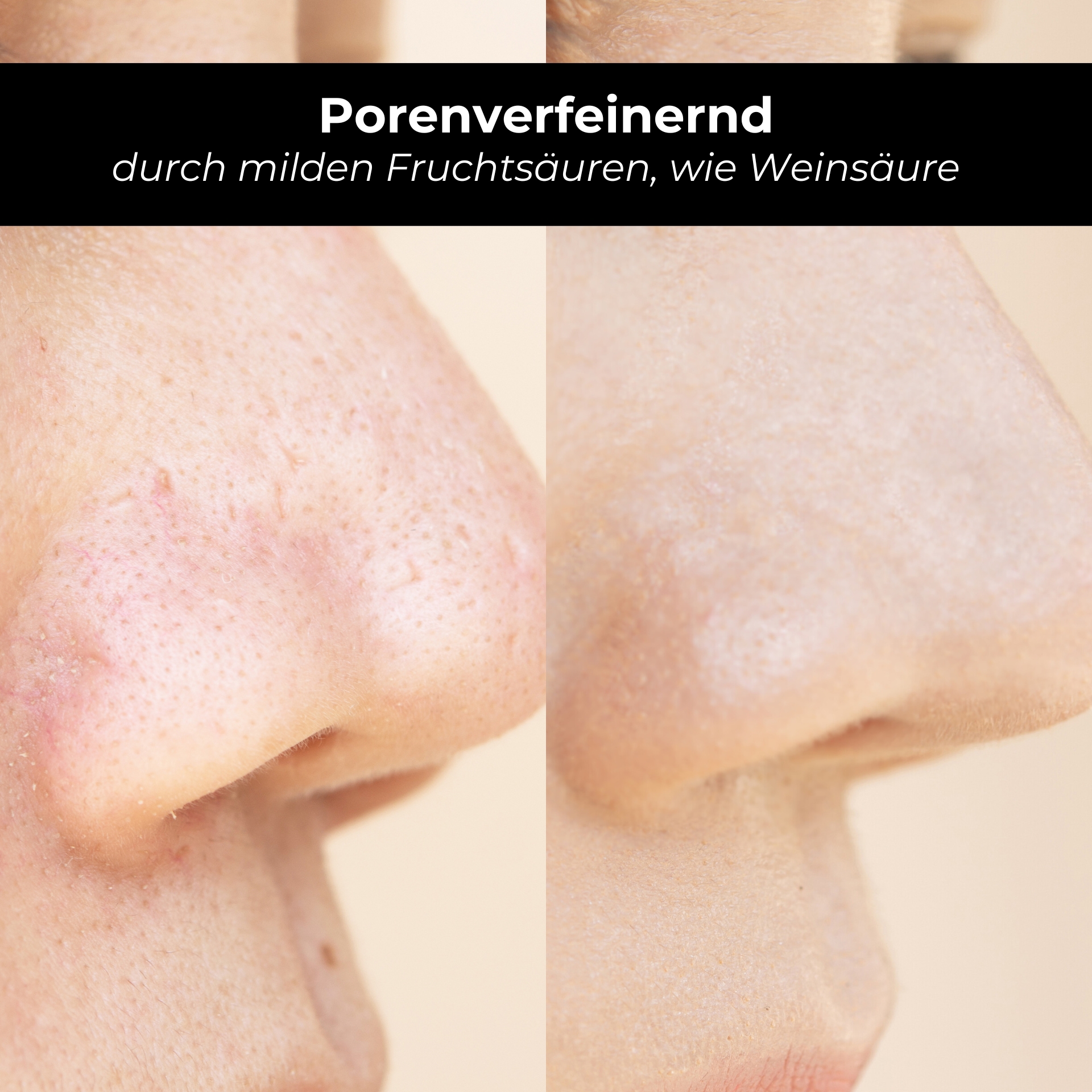 RAU AHA Tonic 50 ml - Refreshing tonic with mild fruit acids. Porenverfeinerndes Hautbild durch milde Fruchtsäuren, wie Weinsäure, vor und nach Anwendung des RAU AHA Tonic.